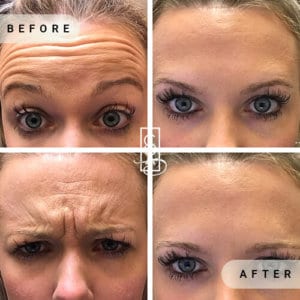 centraloregonaesthetics Botox (2)