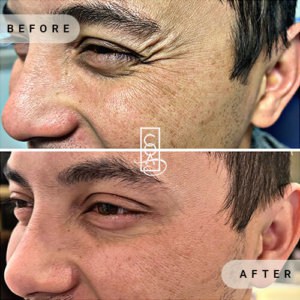 centraloregonaesthetics Botox (4)