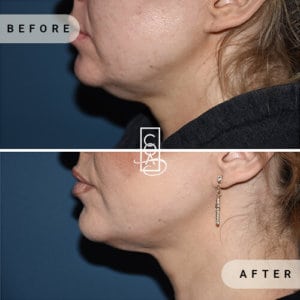 centraloregonaesthetics Kybella (1)