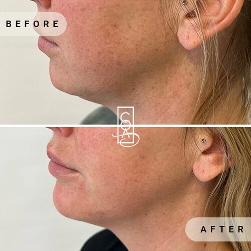 Chin-Augmentation-before-after-in-central-oregon-aesthetics-in-bend-or