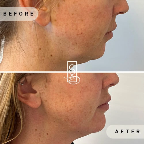 Chin-Augmentation-before-in-central-oregon-aesthetics-in-bend-or