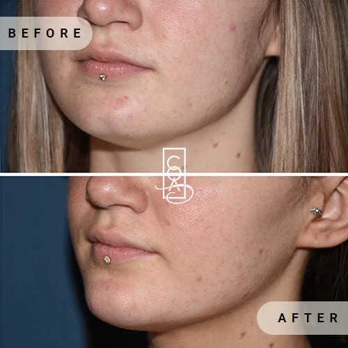 Chin-Augmentation-img-in-central-oregon-aesthetics-in-bend-or