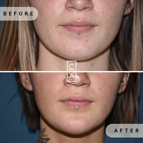 Chin-Augmentation-imgs-in-central-oregon-aesthetics-in-bend-or