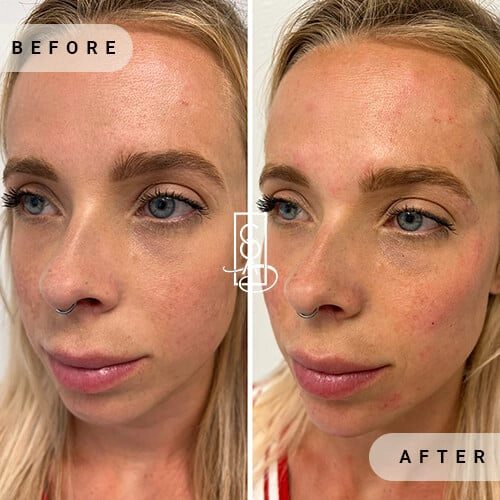 Facial Balancing Before and After at Central Oregon Aesthetics in Bend, OR