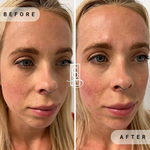 Facial Balancing Before and After | Central Oregon Aesthetics in Bend, OR