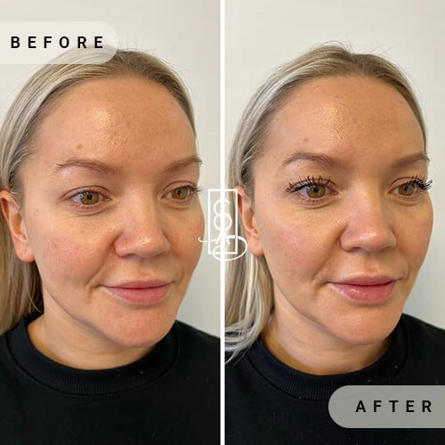 Facial Balancing Before and After in Central Oregon Aesthetics in Bend OR