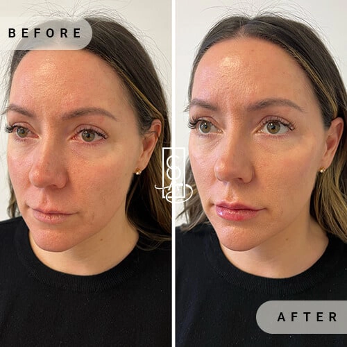 Full-Facial-Balancing-at-central-oregon-aesthetics-in-bend-or