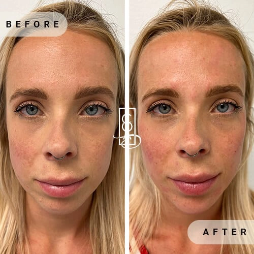 Full Facial Balancing before a after in Central Oregon Aesthetics in Bend OR