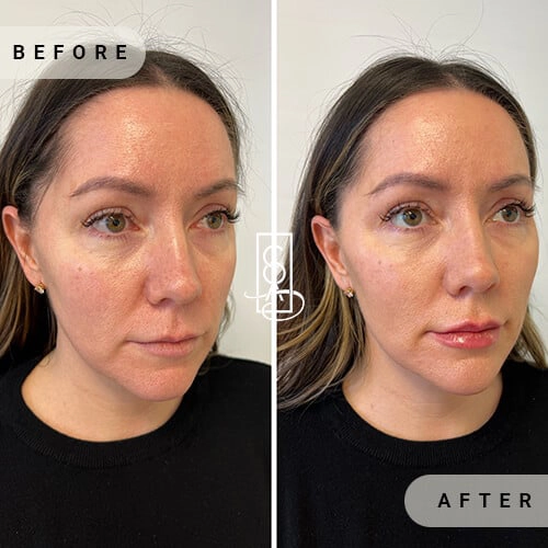 Full-Facial-Balancing-before-adter-at-central-oregon-aesthetics-in-bend-or