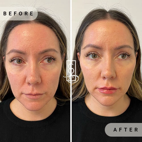 Full-Facial-Balancing-before-after-at-central-oregon-aesthetics-in-bend-or