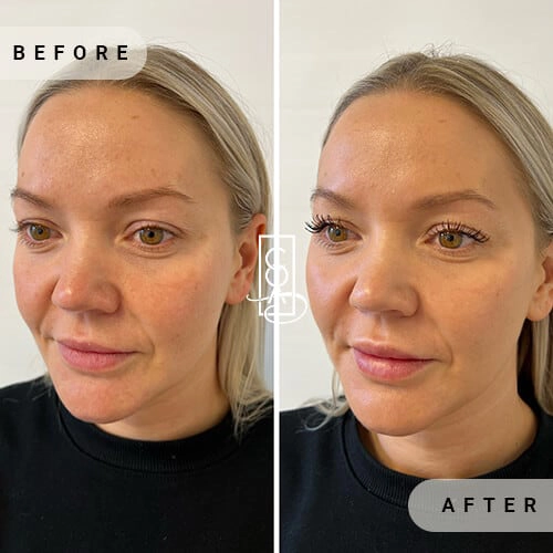 Full Facial Balancing Before and After in Central Oregon Aesthetics
