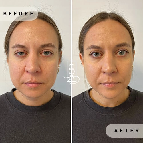 Full-Facial-Balancing-before-and-after-at-central-oregon-aesthetics-in-bend-or