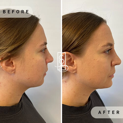Full Facial Balancing Before and After in Central Oregon Aesthetics in Bend OR