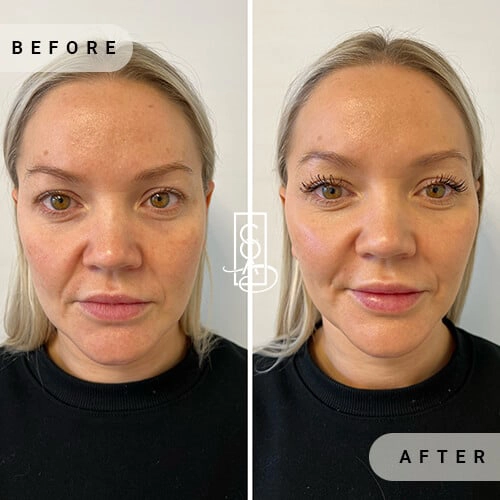 Full Facial Balancing Before and After in Bend OR