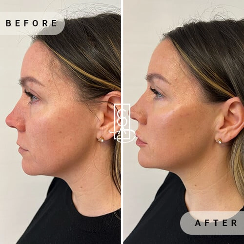 Full-Facial-Balancings-before-after-at-central-oregon-aesthetics-in-bend-or