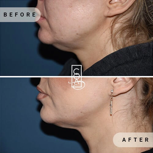 Kybella®-before-after-in-central-oregon-aesthetics-in-bend-or