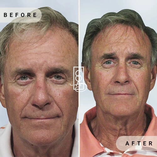 Sculptra-before-after-in-central-oregon-aesthetics-in-bend-or