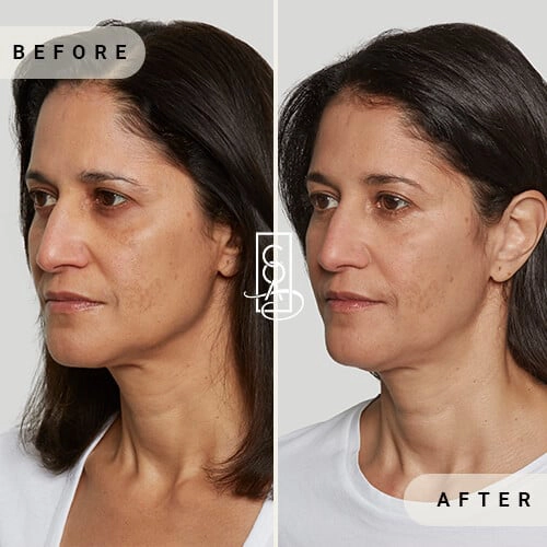 Sculptra-before-and-after-at-central-oregon-aesthetics-in-bend-or