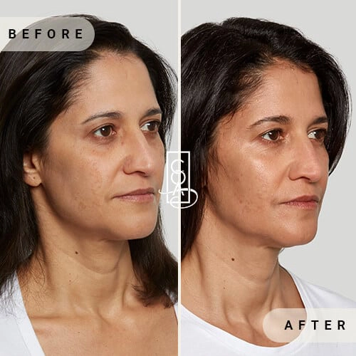 Sculptra-before-and-after-in-central-oregon-aesthetics-in-bend-or