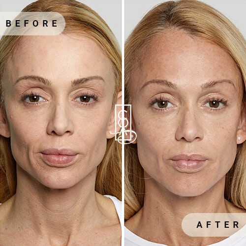 Sculptras-before-after-at-central-oregon-aesthetics-in-bend-or