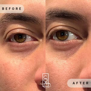 Upneeq®-before-after-at-central-oregon-aesthetics-in-bend-or