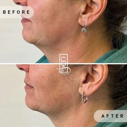 before-after-Kybella®-in-central-oregon-aesthetics-in-bend-or