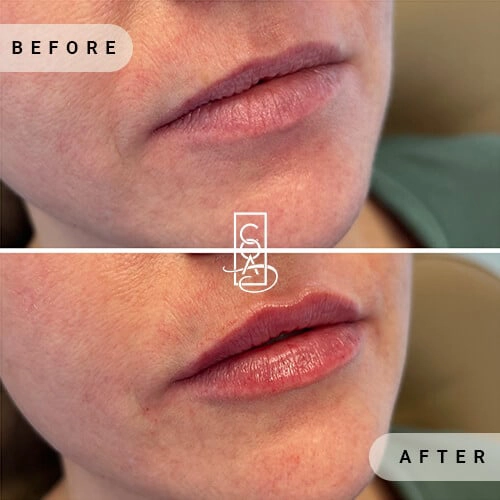 lips before after at central oregon aesthetics in bend or