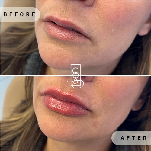 lips before after at central oregon aesthetics