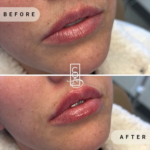 Lips Before and After at Central Oregon Aesthetics in Bend, OR