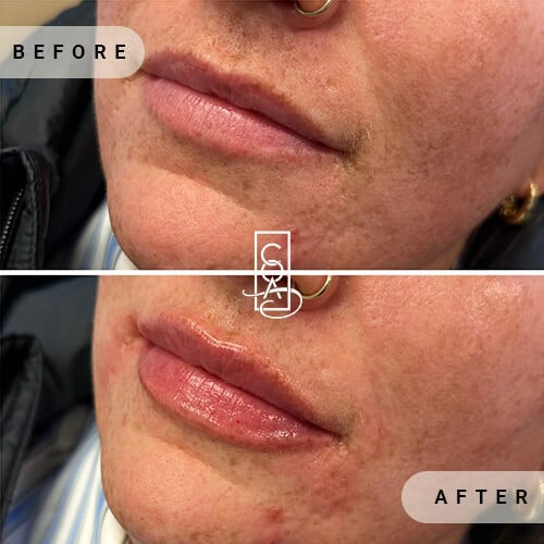 Lips Before and After at Central Oregon Aesthetics