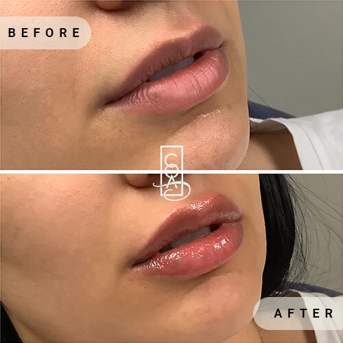 Lips Before and After at Central Oregon Aesthetics in Bend, OR