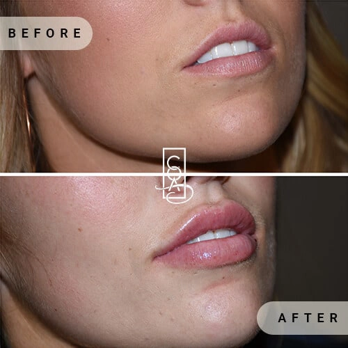 Lips Before at Central Oregon Aesthetics in Bend, OR