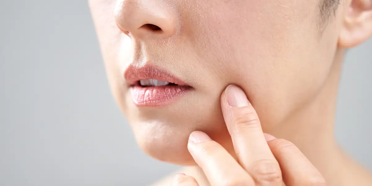 Chemical peel treatment to improve acne scars, fine lines, and uneven skin tone.
